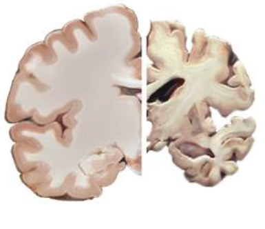 Healthy Brain vs Alzheimer's Disease