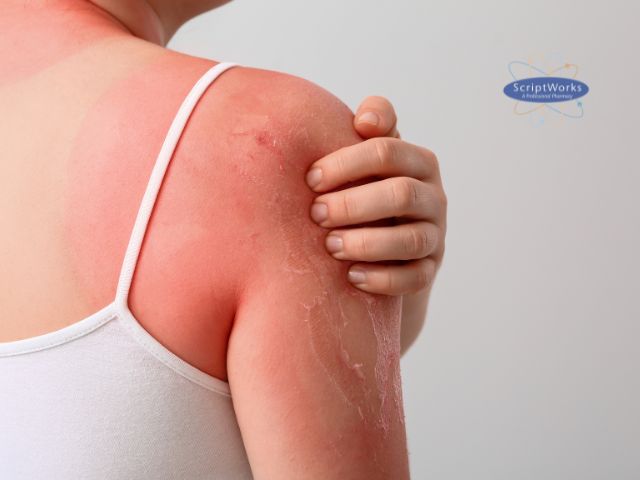 Summer Sunburn Girl with Skin Peeling